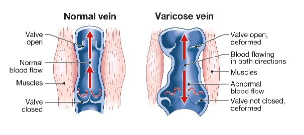 Varicose veins Varicose veins