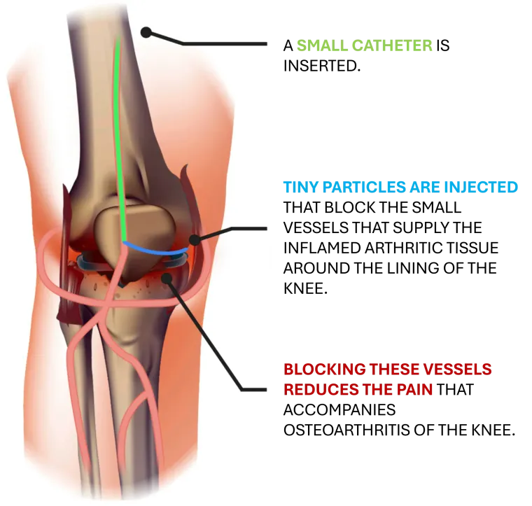 Genicular artery embolization