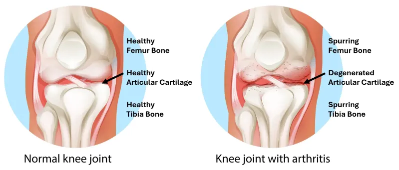 Healthy versus arthritis knee