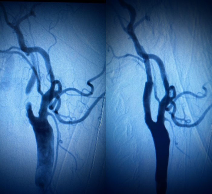 carotid-artery-disease.jpg