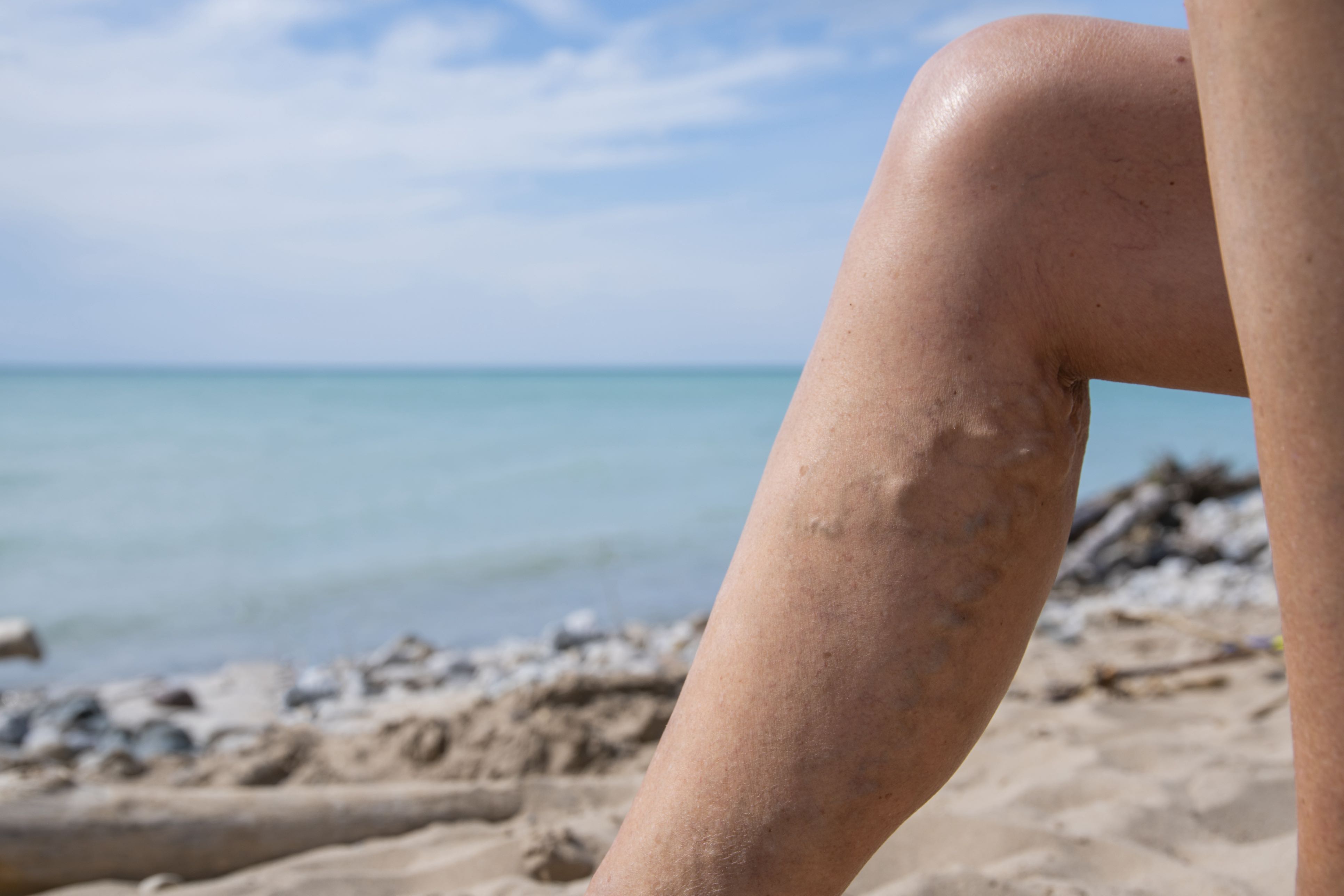 Varicose Veins